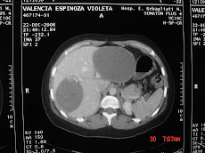 DOS QUISTES HEPÁTICOS HIDATIDICOS