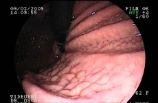 POLIPOSIS GLANDULAR FUNDICA