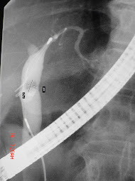 1.- PANCREATITIS AGUDA POST-PCRE