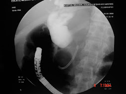 3.- COLANGIOCARCINOMA