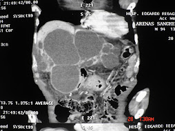 1.- POLIQUISTOSIS HEPÁTICA Y RENAL