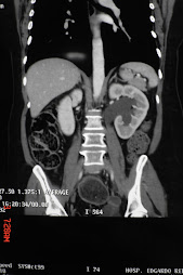 1.- NM RECTOSIGMOIDEO CON URETEROHIDRONEFROSIS