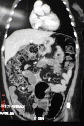 2.- NM RECTOSIGMOIDEO CON URETEROHIDRONEFROSIS