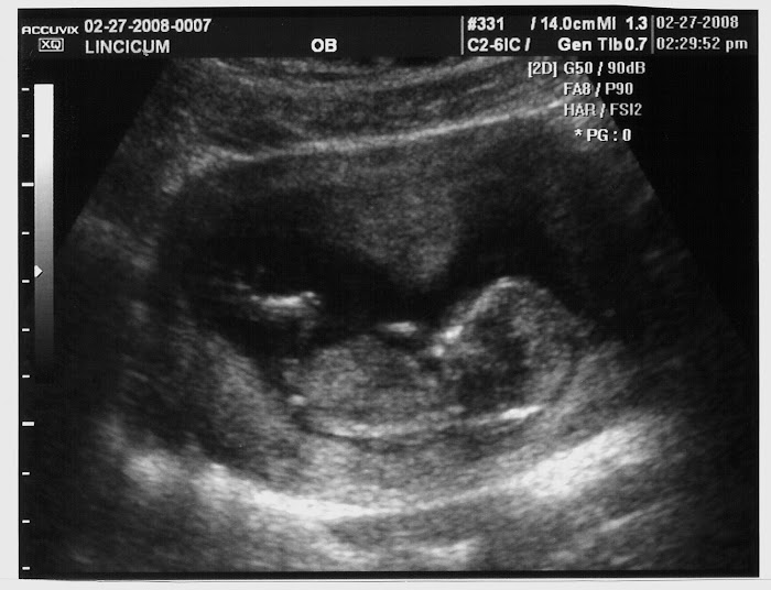 12 Week Ultrasound