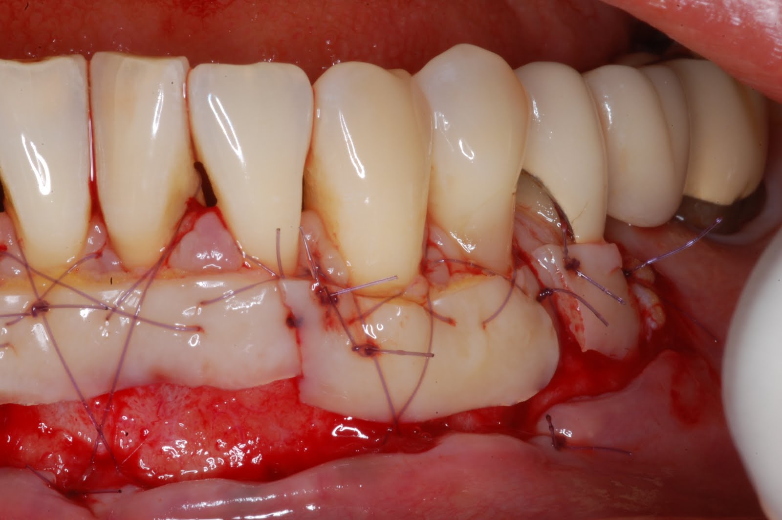 Periodontal Implant Cases By Dr Thomas Kang Free Gingival Grafts