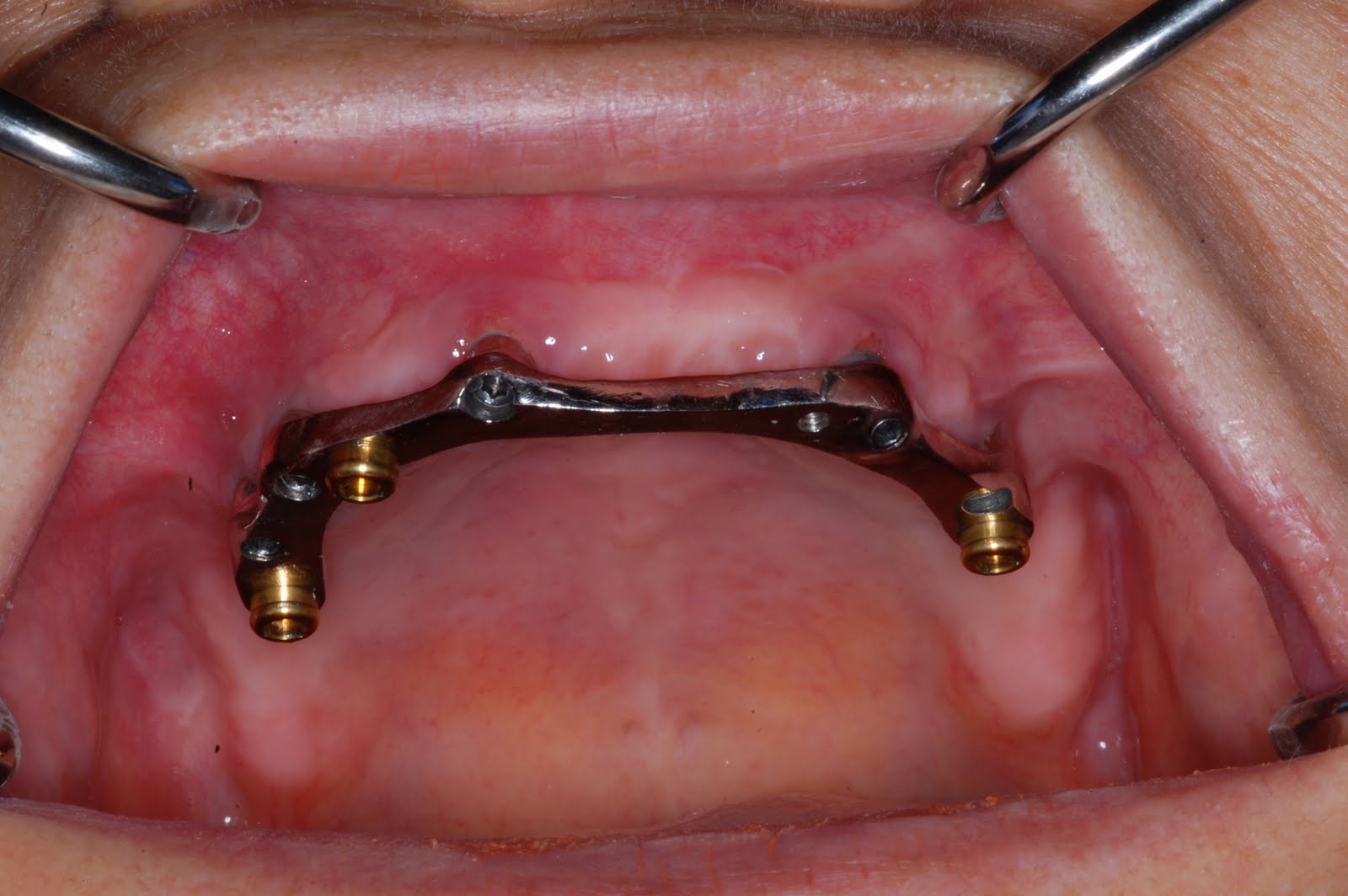 Periodontal Implant Cases by Dr. Thomas Kang A maxillary overdenture case