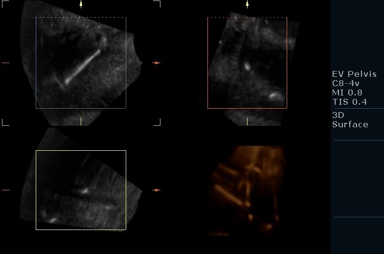 Copper IUD, spotted in Uterus!