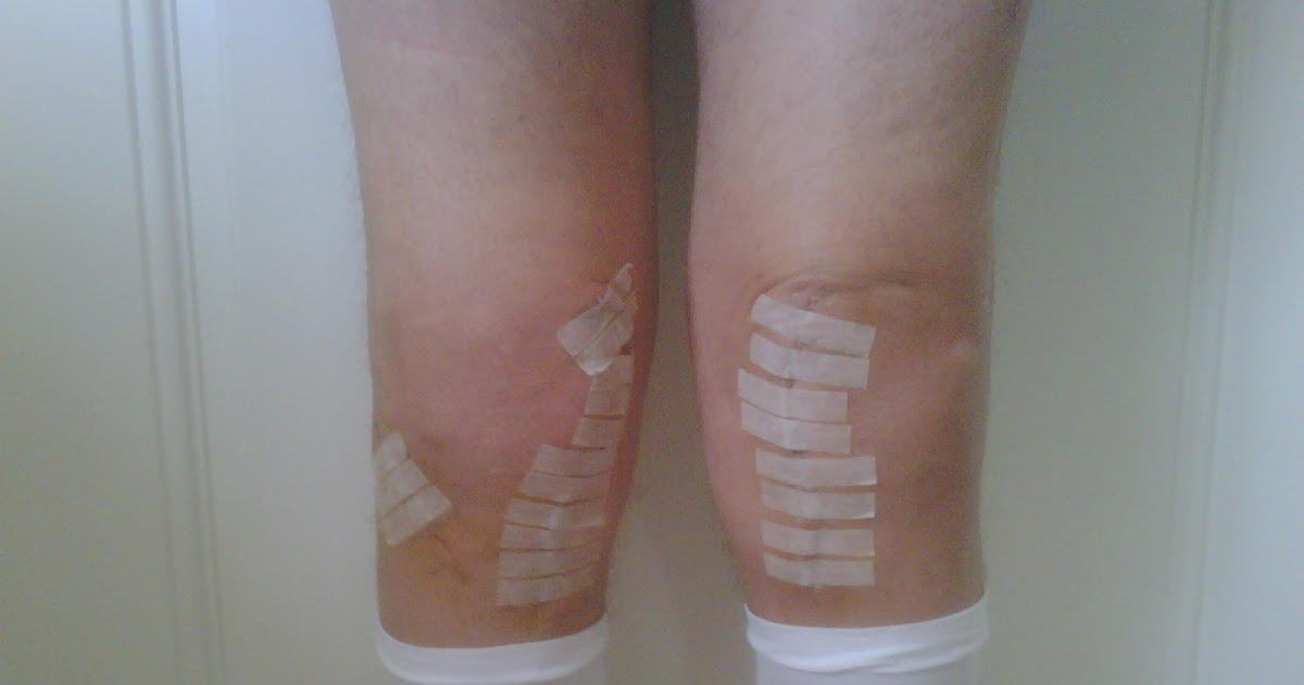 Extreme BiLateral Total Knee Replacement and MaxGXL Staples are Out