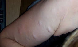 Bumps on Upper Right Arm
