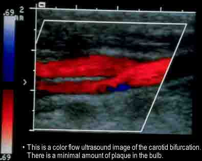Carotid Artery Ultrasound