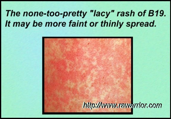 [B19+rash+with++caption.jpg]