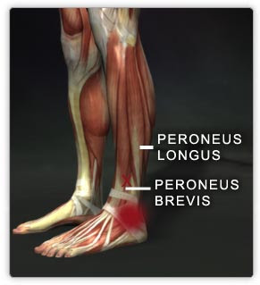 TRAIN OUT PAIN: Peroneals, Hallux Limitus and Ankle Sprains