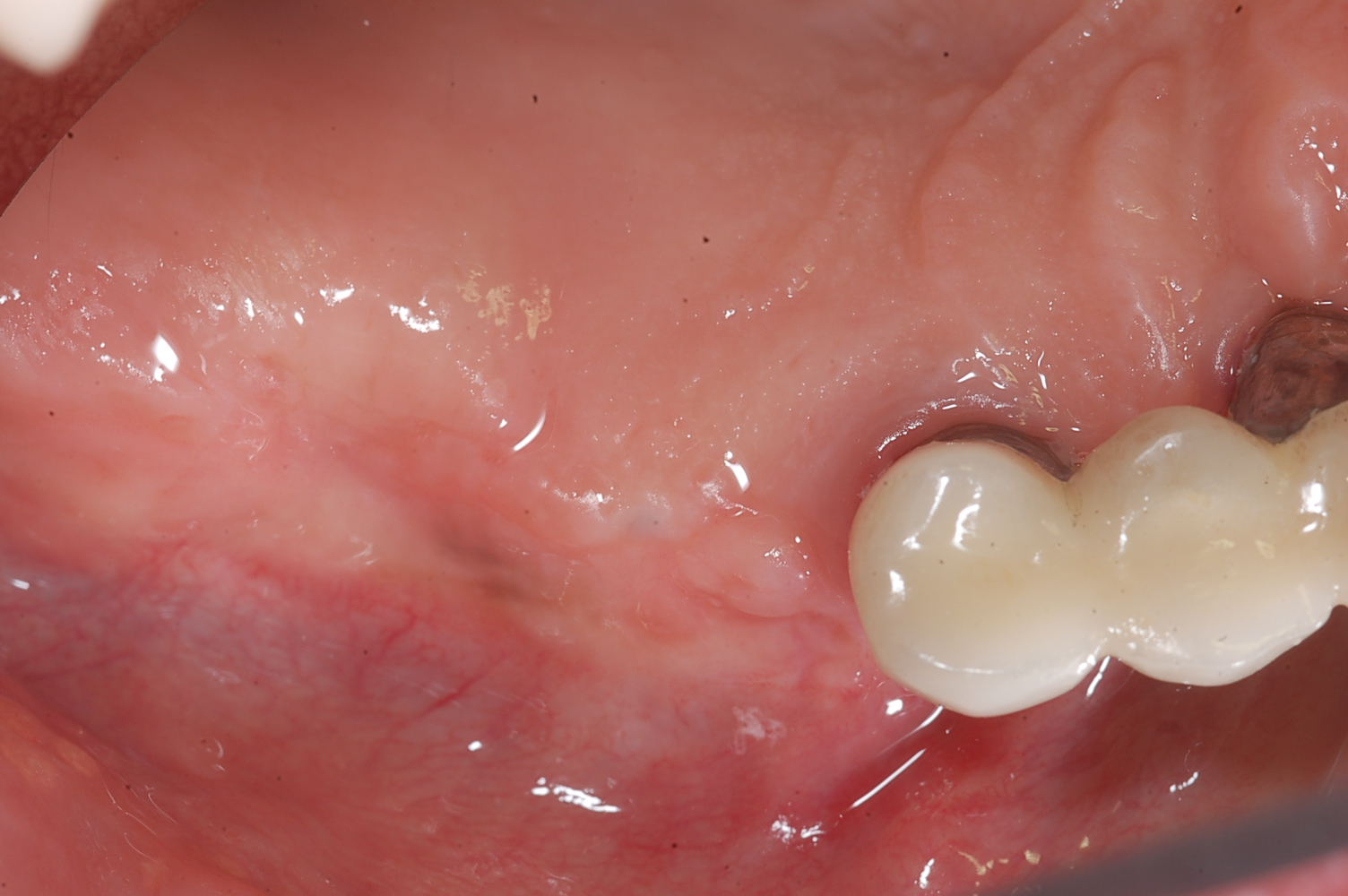 Dental implant professional Sinus membrane perforation Management during sinus lift