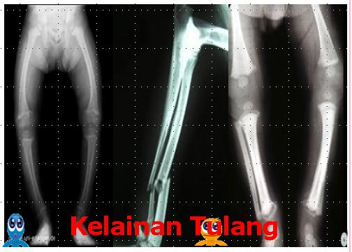 Kelainan Pada Tulang
