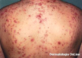 Does primobolan cause acne