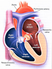 TGA Heart after Arterial Switch, Jatene Procedure.