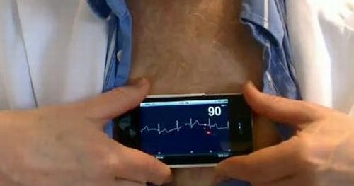The AliveCor iphone ECG is a