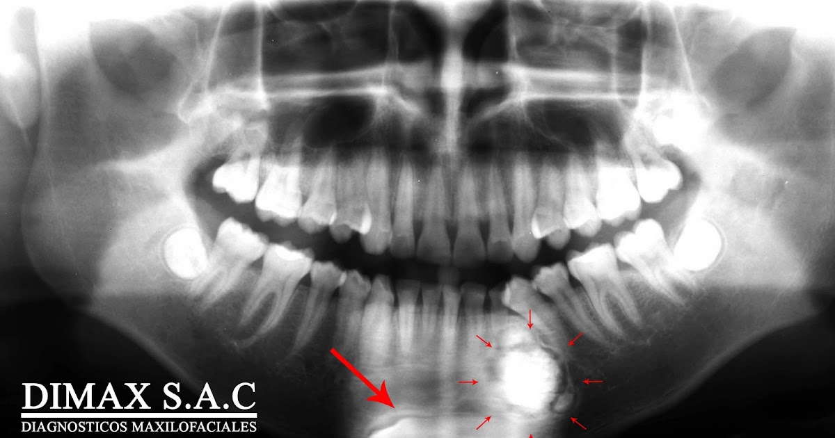 DIAGNOSTICOS POR IMAGENES Odontoma Compuesto 01
