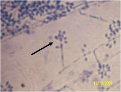 Esporotricosis cutanea