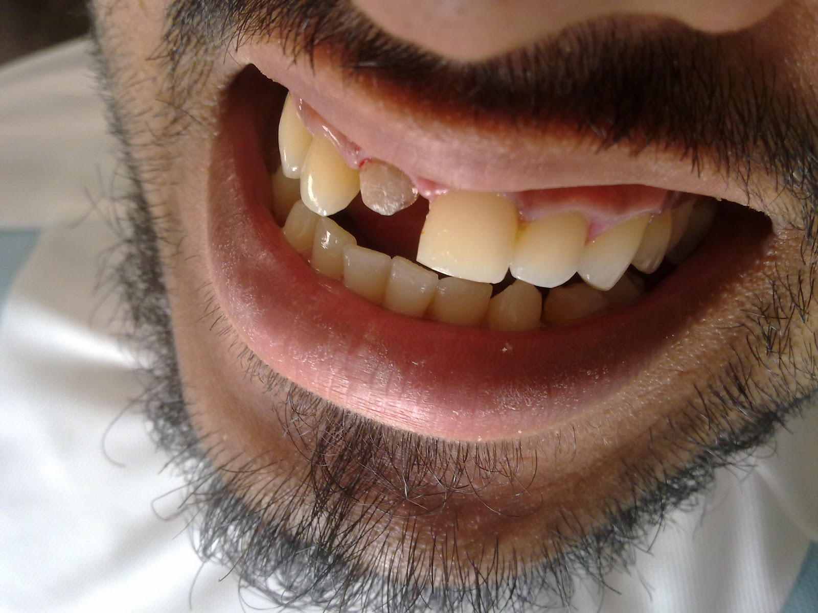 DENTO CARE DENTAL CLINICS 3M LAVA CROWNANTERIOR RESTORATION