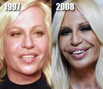 donatella versace chirurgie