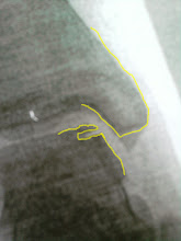 Röntgenaufnahme rechtes Sprunggelenk