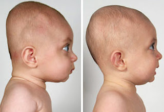 plagiocephaly blogging physiotherapy