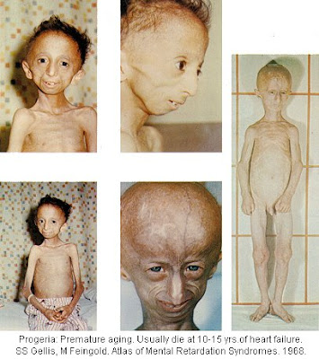 Scientists are particularly interested in progeria because it might reveal 