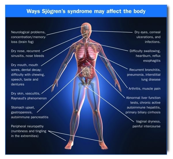 Reasonably Well Glandular and Extraglandular Manifestations of Sjogren