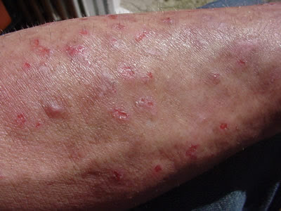 [Bild: arm2.jpgChemtrail Polymers Linked to Morgellons Disease]