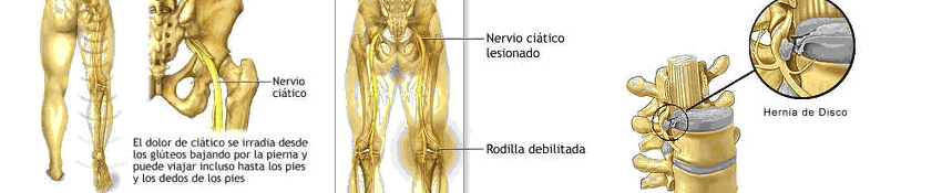 Tratamiento Ciática