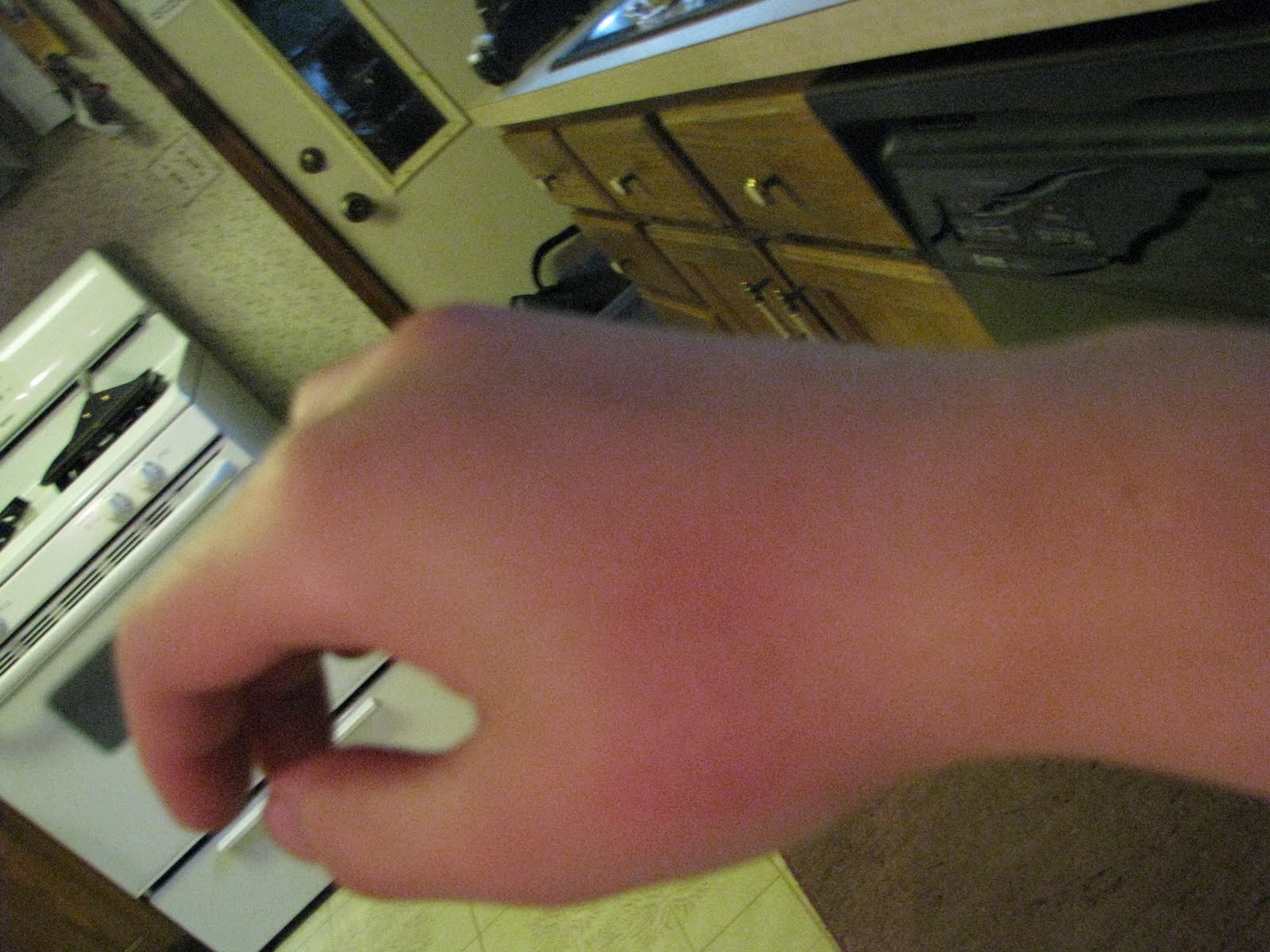 inflamed wrist