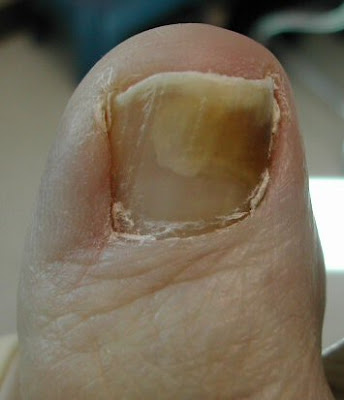 Vicks Toenail Fungus