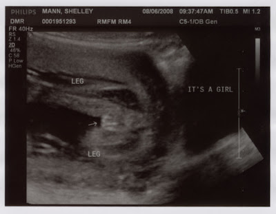 ultrasound gender girl