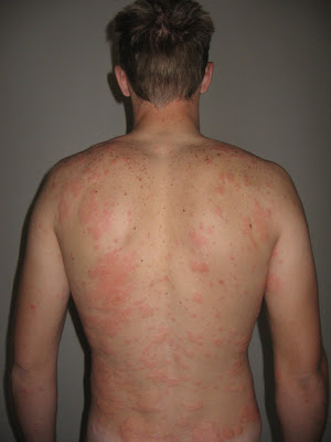 Best steroids for hives