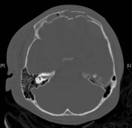 Neurosurgery Traumatic C2 dens fracture (Type II)