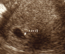 ULTRASOUND PICS OF LITTLE SPECK