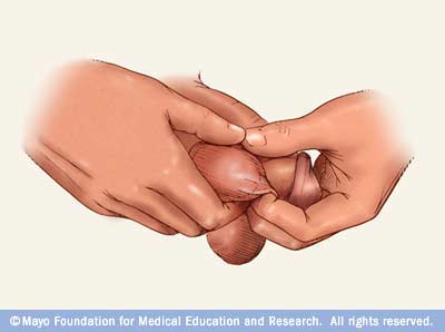 Ectopic+testis