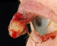 Stye : External Hordeolum