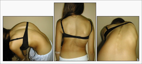 [Scoliosis_Fig08_en.jpg]