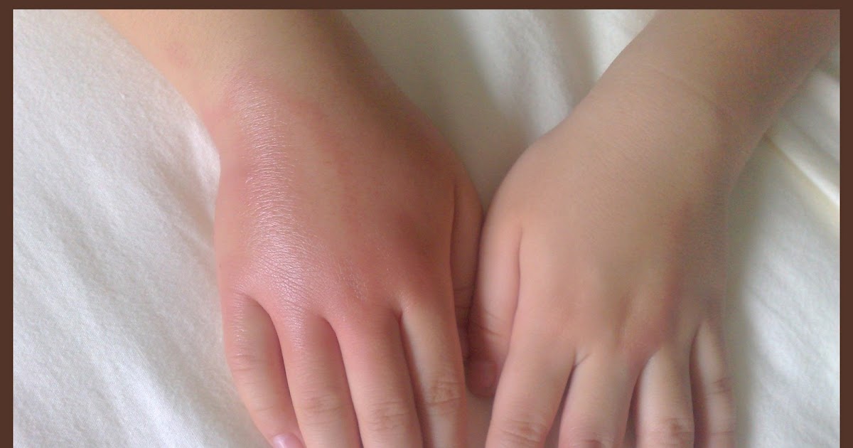 ♥ BabiesLZ ♥ Swollen Hand