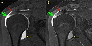 contrast within the joint.