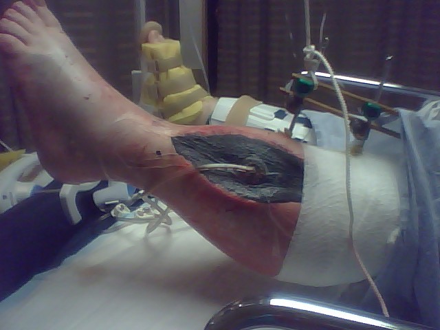 [post+surg+leg.jpg]