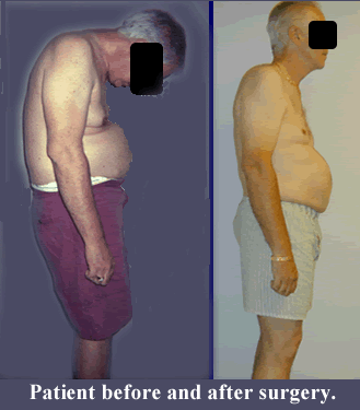ankylosing spondylitis thesis ankylosing spondylitis thesis