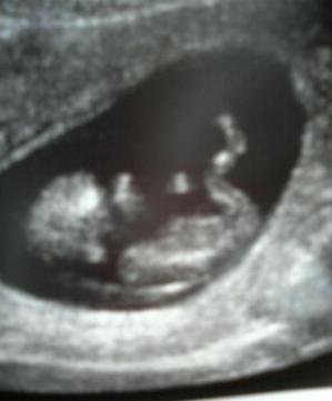 Healthy+heartbeat+at+11+weeks