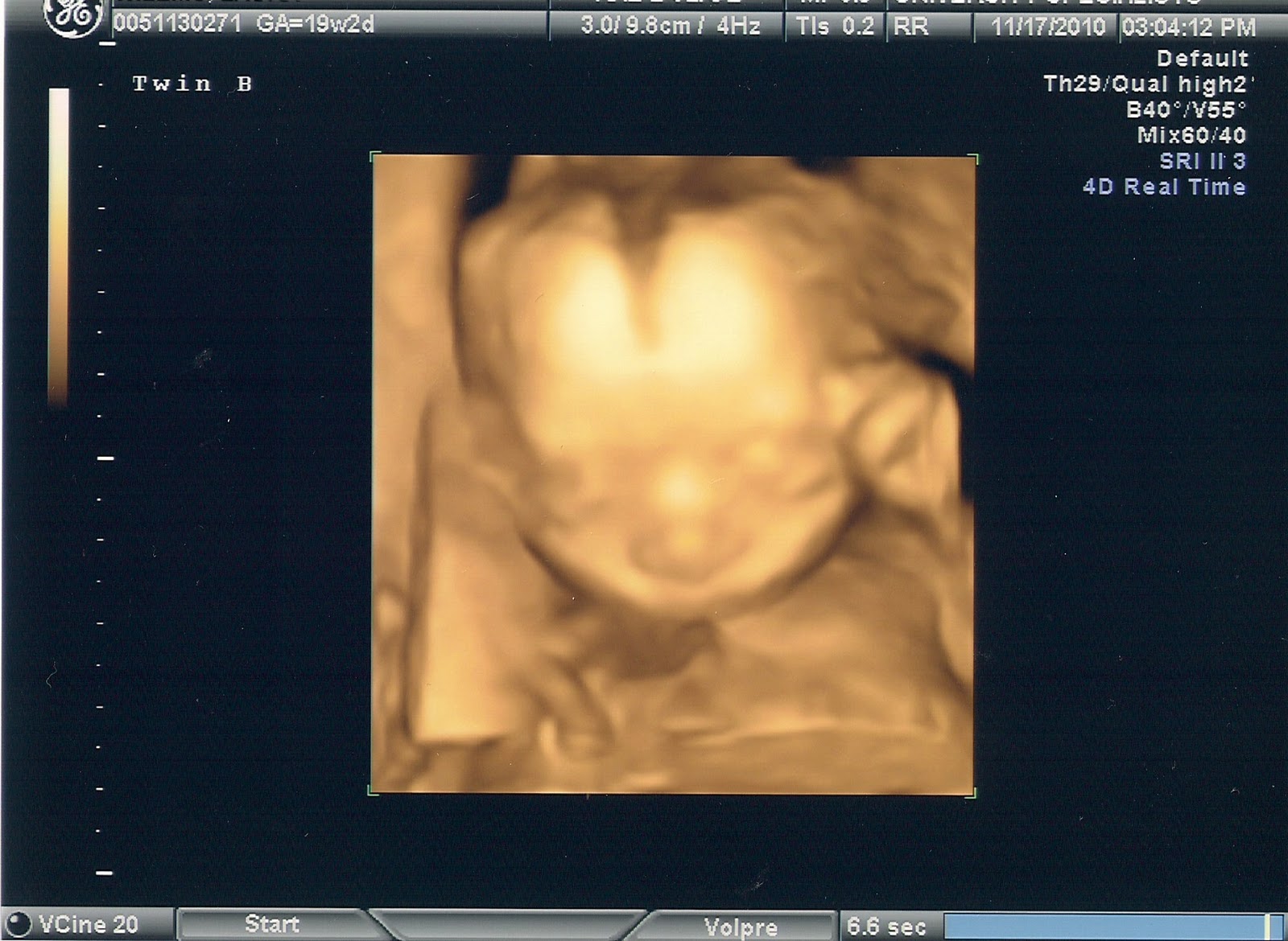 The Willms Level 2 Ultrasound