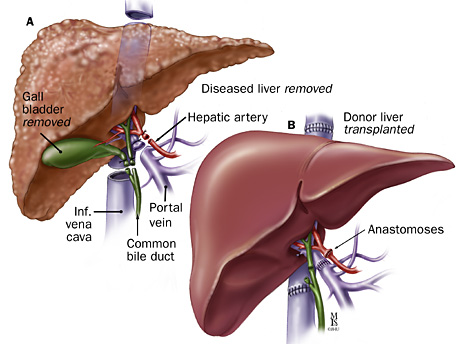 Steroids cause liver cancer