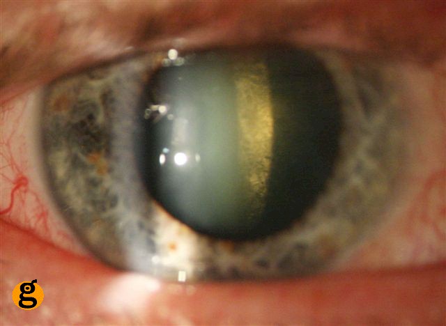 Diabetic Cataract