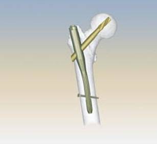 Walking with Big EZ: Time to Fix the Femur