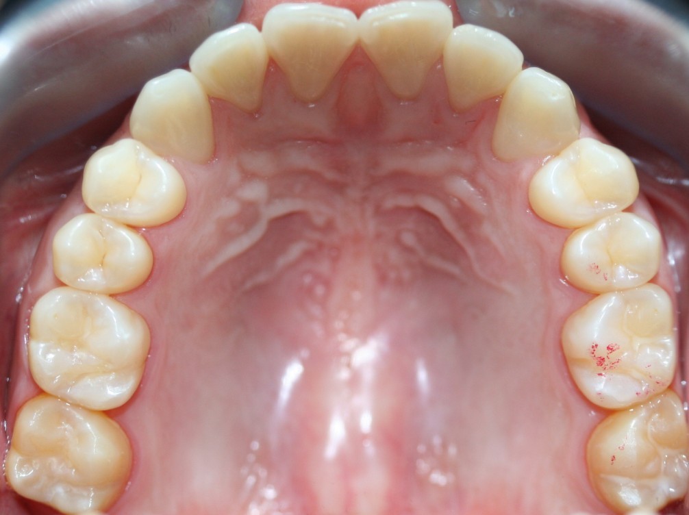 TRATAMIENTOS DENTALES Arcada dental Adulto